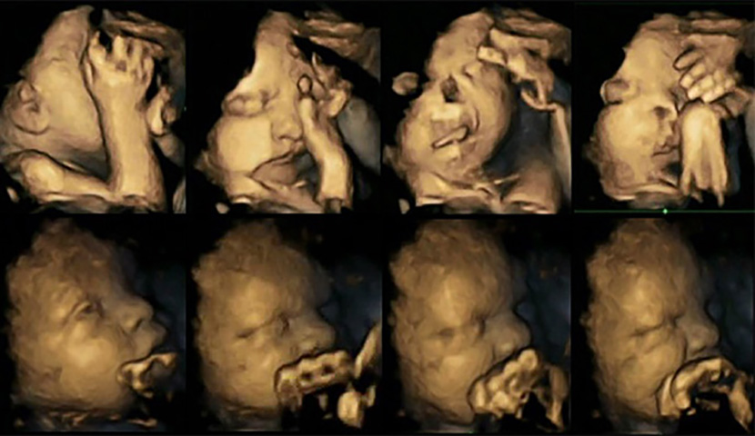 EMBARGOED TO 1000 MONDAY MARCH 23 BEST QUALITY AVAILABLE Undated composite handout images issued by Durham University of 4-d ultrasound scans showing a sequence of movements displayed by two fetuses at 32 weeks gestation which shows fetal movements in a fetus whose mother is a smoker (top) and a fetus whose mother is a non-smoker (below). Dr Nadja Reissland from Durham University has researched scans of unborn babies whose mothers smoke and detected tiny differences in their movements from those whose mothers do not smoke. PRESS ASSOCIATION Photo.Issue date: Monday March 23, 2015. See PA story HEALTH Scan. Photo credit should read: Dr Nadja Reissland/PA Wire NOTE TO EDITORS: This handout photo may only be used in for editorial reporting purposes for the contemporaneous illustration of events, things or the people in the image or facts mentioned in the caption. Reuse of the picture may require further permission from the copyright holder.